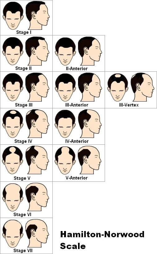 Androgenetic Alopecia: The Current Theory Has Problems!