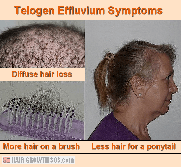 hair loss telogen effluvium