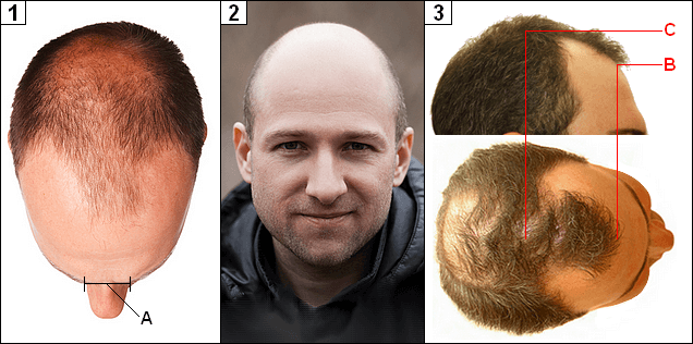 Frontal Fibrosing Alopecia Dermnet Nz