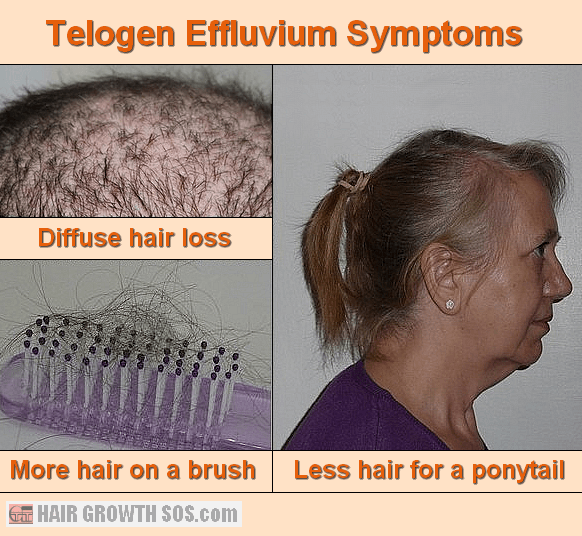 Chronic Telogen Effluvium Symptoms, Causes And How To Stop It